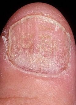 гъбички на ноктите на краката
