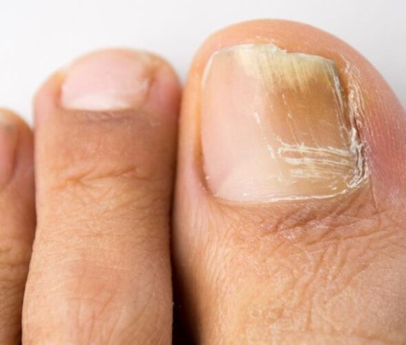 гъбична инфекция на ноктите на краката
