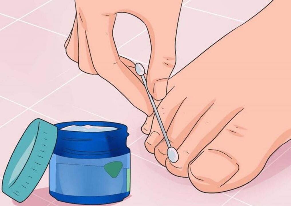прилагане на мехлем за лечение на гъбички по ноктите