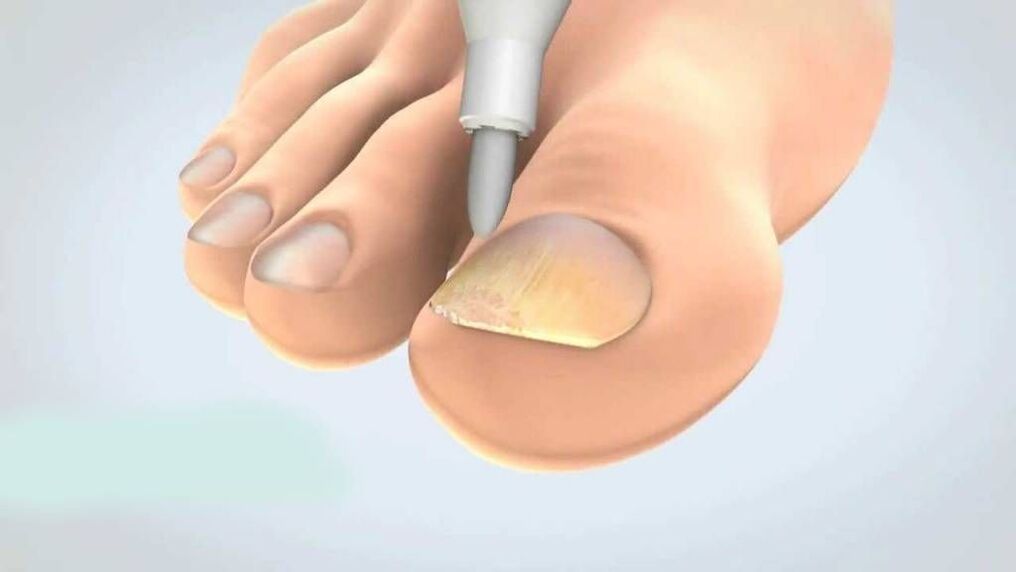 лечение на гъбички по ноктите на краката