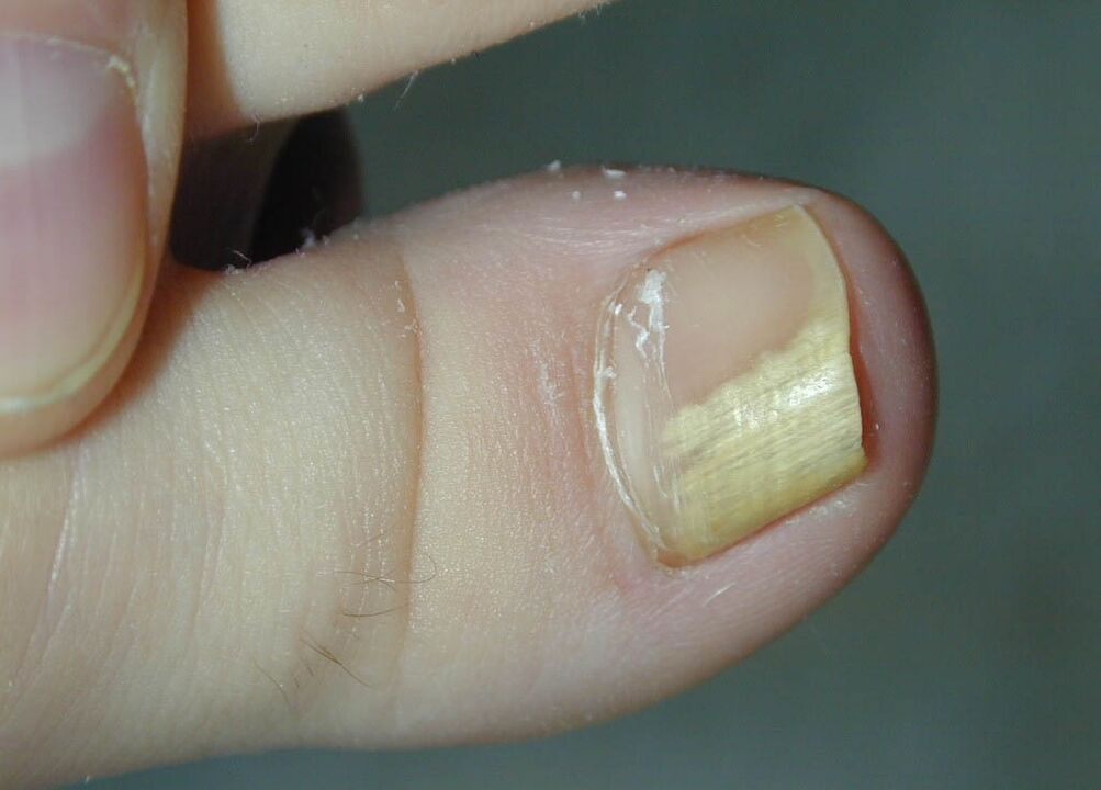гъбична инфекция на нокътната плочка
