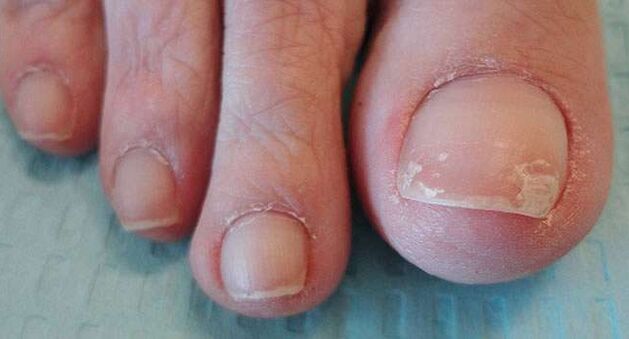 Един от симптомите на онихомикоза е отлепването на нокътната плочка. 