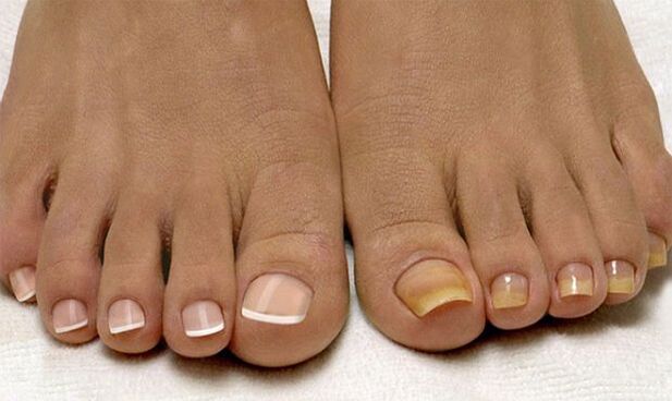 Здрави нокти на краката (вляво) и засегнати от гъбички (вдясно)