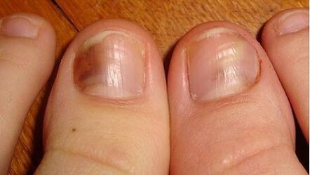 Признак на микоза е потъмняването на нокътната плочка