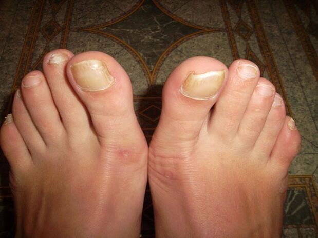 Удебеляване на ноктите на краката при онихомикоза