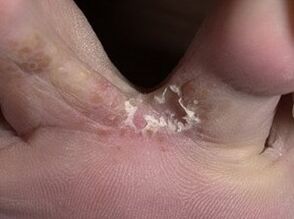 симптоми на гъбички на пръстите на краката