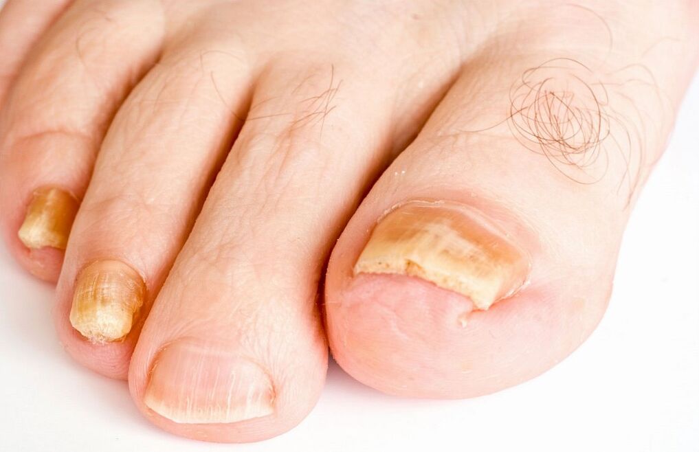 гъбички по ноктите на краката