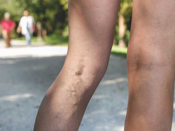 Разширените вени са рисков фактор за инфекция с гъбички по краката
