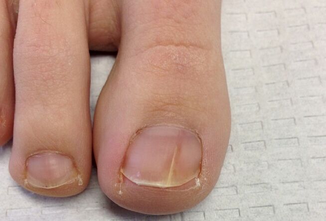 Визуални прояви на гъбички по ноктите на краката в началния стадий