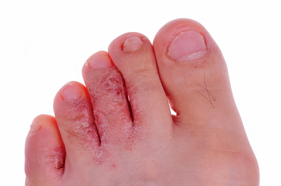 гъбична инфекция на кожата между пръстите на краката