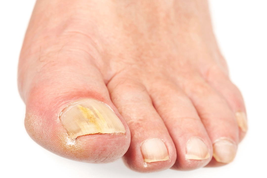 гъбична инфекция на нокътните плочи