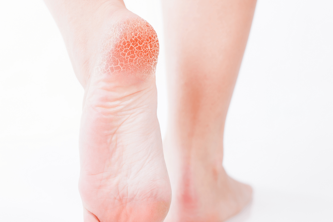 лечение на ранен стадий на гъбички по краката