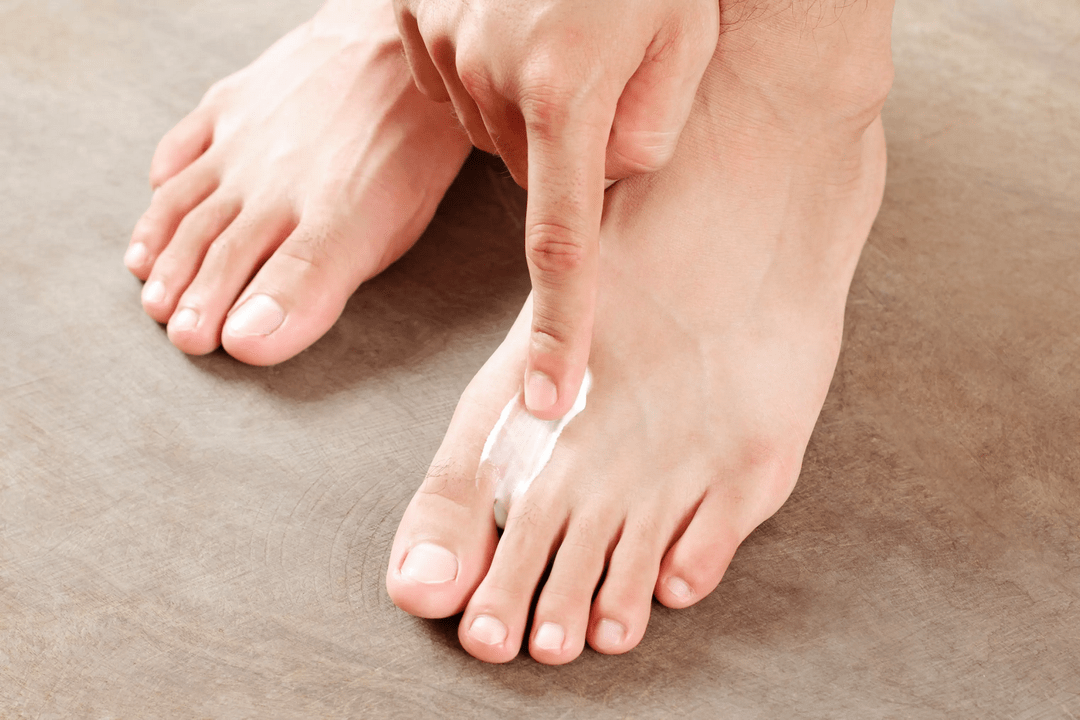 прилагане на противогъбичен мехлем върху кожата на краката