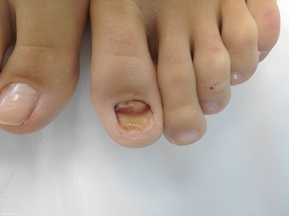 гъбични заболявания на ноктите