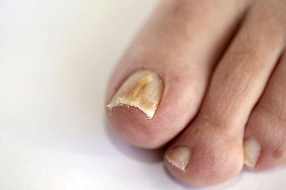 симптоми на гъбички по ноктите на краката