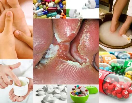 Интердигитална микоза и методи на лечение